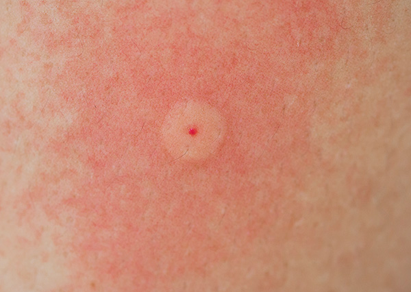 Voyons combien de temps une personne présente généralement les premiers symptômes de maladies après une piqûre de tique ...