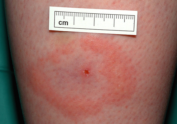 Marque de morsure de tique