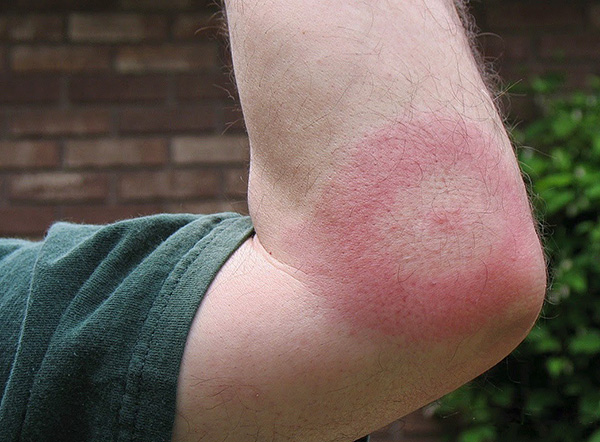 Un tel anneau peut progressivement augmenter de diamètre.