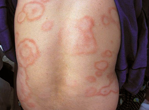 Un érythème en anneau peut également apparaître sur des zones du corps où il n'y a pas eu de piqûres.