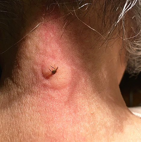 Une bosse qui démange se forme souvent sur le site d'une piqûre de tique.