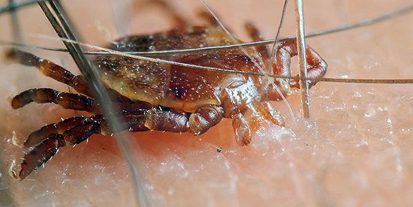 La photo montre une tique de la taïga attachée à la peau.