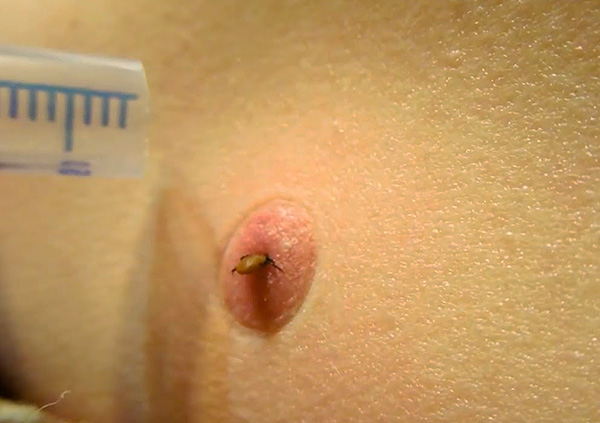 La tique ne peut pas être retirée de la peau en créant un vide avec une seringue.