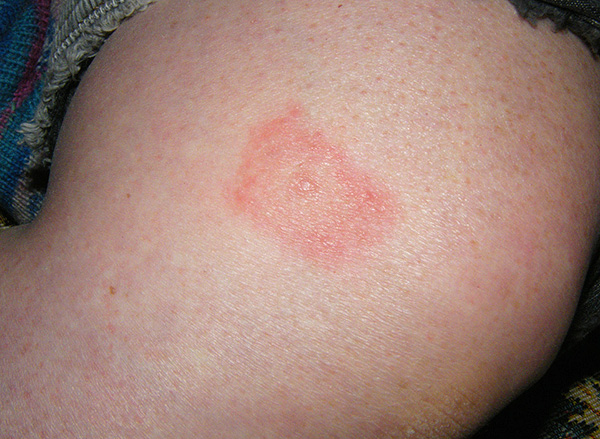 Voici à quoi ressemble une morsure de tique