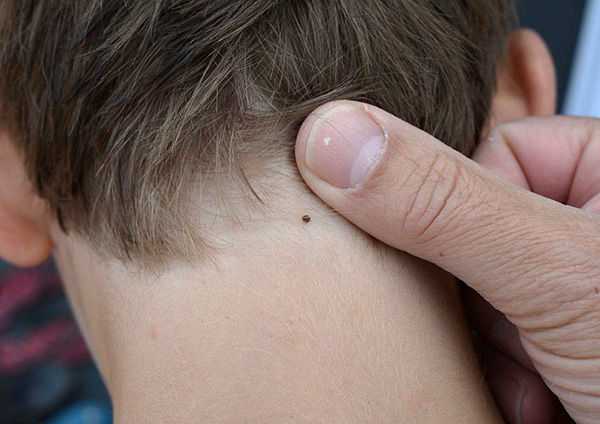 La tique collée au cou de l'enfant