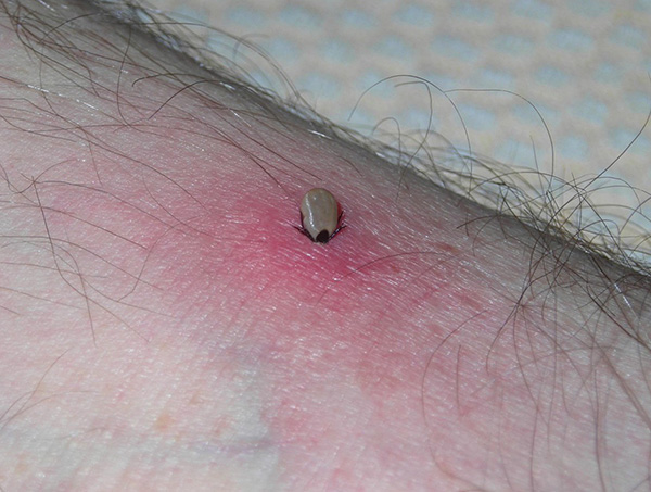 Le plus souvent, une personne est mordue par des individus adultes de chiens et de tiques de la taïga, ainsi que par leurs nymphes.