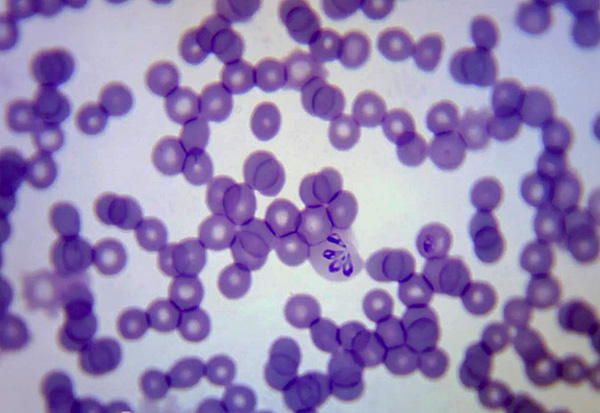 Babesia dans le sang