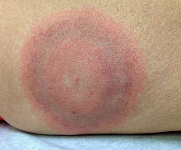 Au fil du temps, à partir du site de la morsure, l'agent infectieux se propage dans tout le corps.