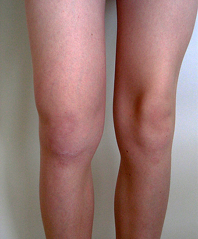 Conséquences de la borréliose de Lyme