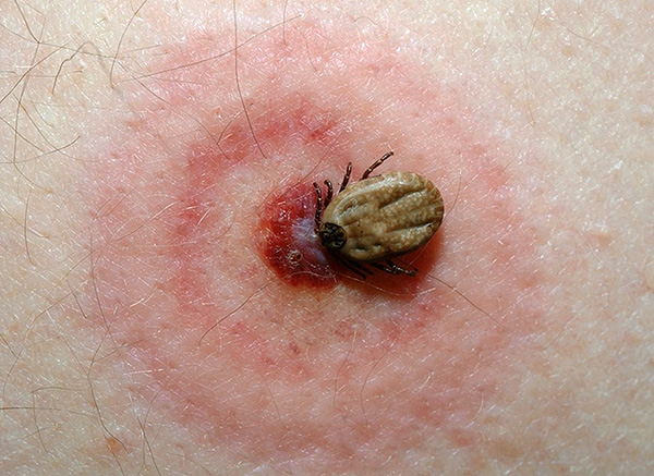 Érythème annulaire autour du site d'une piqûre de tique