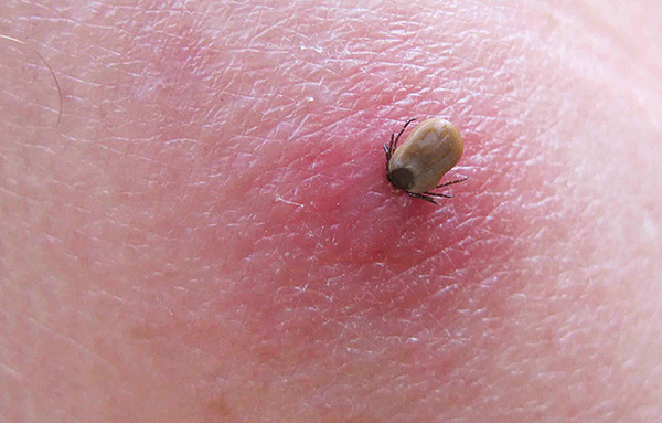 Tique Ixodid attachée à la peau humaine