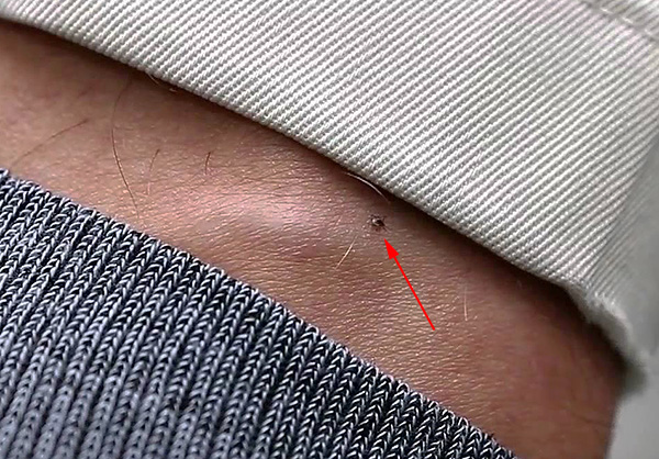 Il est important d'inspecter régulièrement le corps pour les tiques attachées.