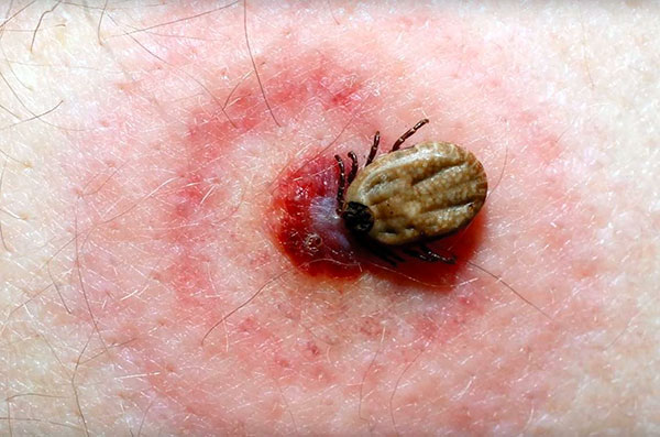 Anneau rouge sur la peau après une piqûre de tique borréliose