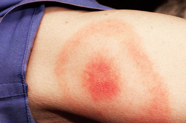 Borréliose transmise par les tiques (trace au site de la morsure)