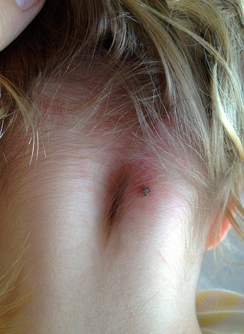 La tique coincée dans le cou