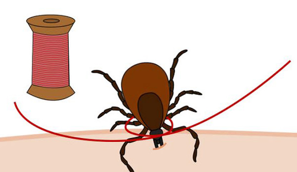 Nous découvrons à quel point il est facile d'arracher une tique avec un fil et comment le faire correctement...