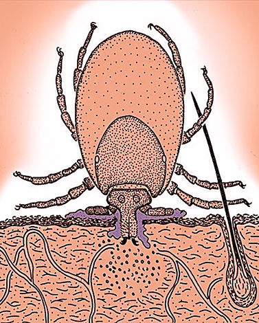Infection par encéphalite par la salive d'une tique mordue