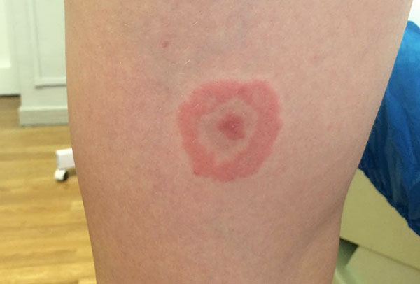 Anneau rouge autour de la piqûre de tique