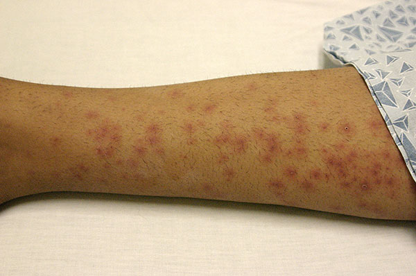 Typhus après piqûre de tique