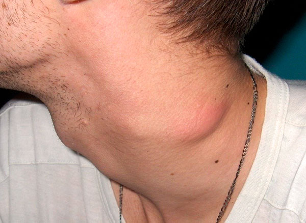 Une tique peut infecter les humains avec la tularémie