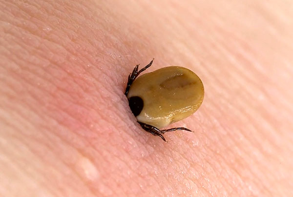 Infection après une piqûre de tique