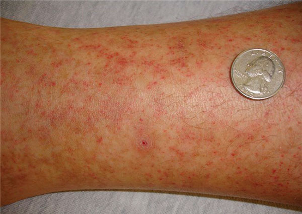 Éruptions sur le corps causées par la fièvre pourprée des montagnes Rocheuses