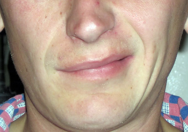 Névrite du nerf facial après borréliose