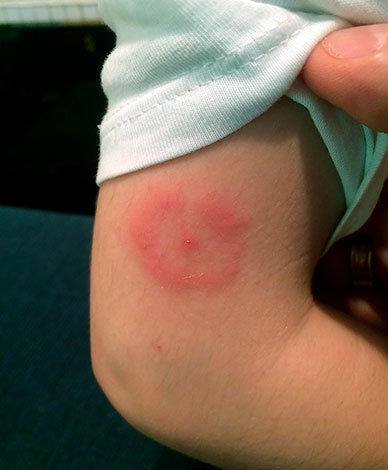 Inflammation après une piqûre de tique