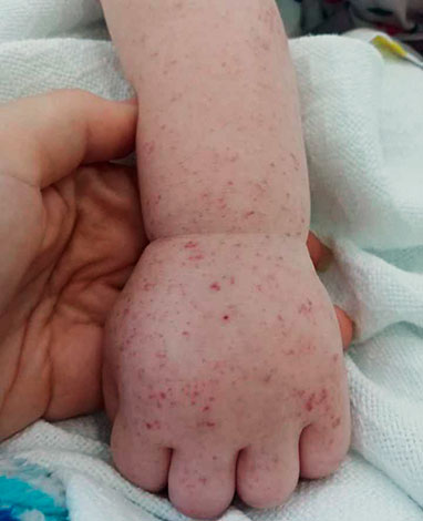 Éruption cutanée dans la fièvre des montagnes Rocheuses