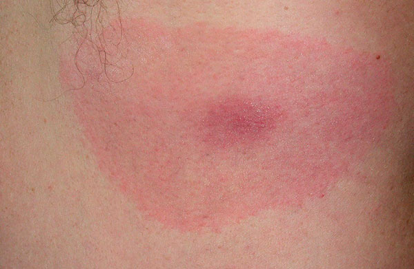 Érythème dans la maladie de Lyme