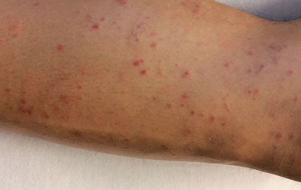 Eruption dans la fièvre de Marseille