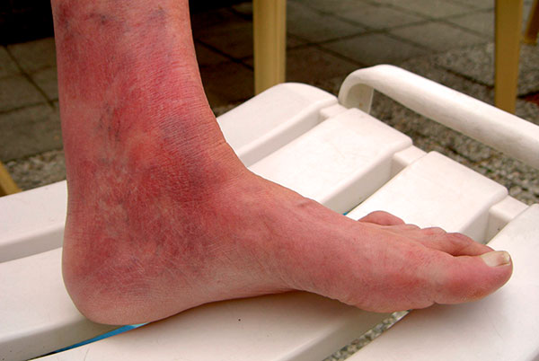 Lésions articulaires dans la borréliose chronique