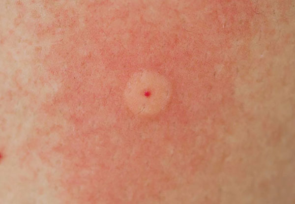 Rougeur autour de la piqûre de tique